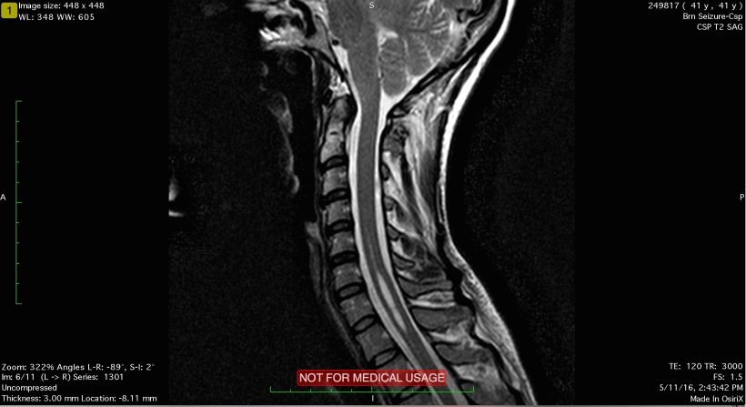 My MRI image showing a silvery cavity in my spinal cord.